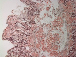 Small_bowel_duodenum_with_amyloid_deposition_congo_red_10X